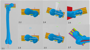 Description of the method. (2.1) The guide is positioned perpendicular to the longitudinal axis of the femur. (2.2) Cephalocaudal view of the guide positioning. (2.3) Same view as 2.2 but showing the axes of rotation of the guide. All (or virtually all) 3D design and imaging software allows objects to be rotated in all three directions of the space. Once the guide is positioned as shown in the figure, the axial plane of the guide should be rotated until the central line (purple) is parallel to the femoral neck (2.4.) with incorrect positioning; (2.5) with correct positioning. The yellow and orange lines should be parallel to the anterior and posterior aspect of the femoral neck to ensure that the guide is completely parallel to the neck in the axial plane. Once positioned, we can assess its correct alignment also from an axial view (2.6). The purple and green lines allow us to see that the guide is correctly positioned in the coronal plane, although its coronal inclination would not affect the axial measurement (2.7).