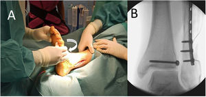 External rotation stress manoeuvre (arrow) of the syndesmosis. (A) Clinical view. (B) X-ray image of lesion with increased CMS and loss of tibiofibular overlap.