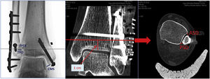 Measurements in mortise projection and in CT study. ASD: anterior syndesmosis distance; PSD: posterior syndesmosis distance; CMS: clear medial space; TFCS: tibiofibular clear space; Arrow: axial cut level at 1cm from the joint line; TFO: tibiofibular overlap.