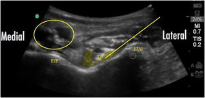 Posición de la aguja y propagación del anestésico local. EIAI: espina iliaca anteroinferior; EIP: eminencia iliopectínea; TP: tendón del psoas; círculo: paquete neurovascular femoral; la línea representa la aguja, y la zona sombreada, el anestésico.