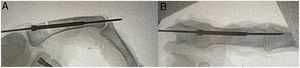 Anterograde intramedullary compression screw technique: (A) intra-articular anterograde and (B) trans-articular anterograde.