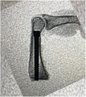 Retrograde intramedullary compression screw technique.