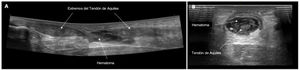 El diagnóstico se confirma mediante ecografía en todos los pacientes (A: Sección longitudinal de la rotura del tendón de Aquiles, B: Sección transversal de la rotura del tendón de Aquiles).
