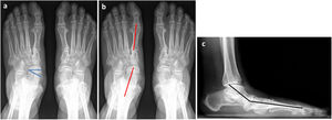 (a and b) Dorsoplantar loading X-ray. Talonavicular coverage angle (blue). Talar-1 metatarsal angle (red). (c) Lateral loading X-ray. Meary's line (black). The colour of the figure can only be seen in the electronic version of the article.