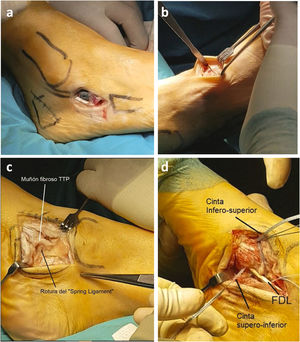 (a) Evans’ osteotomy. (b) Cotton's osteotomy. (c) Degenerated posterior tibial tendon and ruptured spring ligament. (d) Repair of the calcaneonavicular ligament.