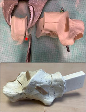 Top – the calcaneal tuberosity was osteotomised to simulate remove varus stability, medial buttress and dissociate the tuberosity with (*) showing the 0.5cm medial wedge of Sawbone®. Bottom – Sawbone® model replicating Sanders 2-B. The subtalar posterior facet was reduced and fixed with a cannulated 4.5mm screw into the ST fragment.6 An 8 hole locking plate was placed on the lateral wall and locked with 3.5mm screws as illustrated in Fig. 2.