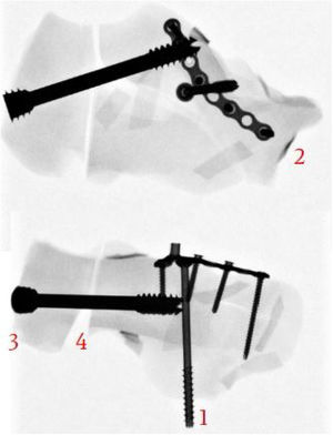 Image guided fluoroscopy radiography was used to verify construct positions. This radiograph demonstrates: (1) Single cannulated 4mm screw into sustentacular (ST) fragment. (2) Locking plate (8-hole) on lateral wall with 3.5mm screws. (3) 7.0mm MUC screw (partially threaded 16mm) placed under guide wire technique to achieve <5mm from subchondral bone. (4) Manual reduction for neutral alignment to prevent compression and varus malreduction.