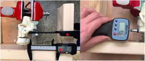 Dual callipers used to measure displacement of the tuberosity with respect to the body.