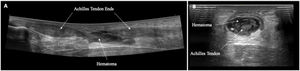 Diagnosis is confirmed by ultrasonography in all patients (A and B).