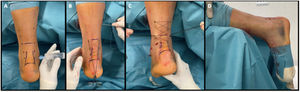 The tendon is repaired with the modified repair Bunnell configuration (A–D), using vicryl (polyglactin) No. 1 (Ethicon, Inc.) being the ends of the sutures harvested and tied medially and laterally at the height of the rupture, maintaining the ankle in 20° of plantar flexion.