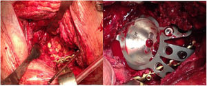 A, B) Imágenes intraoperatorias de un paciente con defecto acetabular tipo IIIB de Paprosky asociado a discontinuidad pélvica en el que se utilizó aloinjerto de esponjosa para el relleno del defecto y una placa para estabilización de la columna posterior (A) asociada a un cotilo tipo Cup-Cage de titanio trabecular (Delta-RevisionTT [Lima Corporate®]) (B). TT: Titanio trabecular.