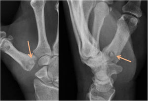 AP and lateral postoperative X-ray, showing the trapezium fragment blocking the flexor carpi radialis plasty at the tunnel entrance at the base of the first metacarpal.