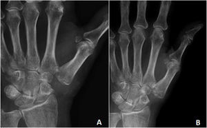 2 year follow-op X-ray. Showing minimal collapse of the metacarpophalangeal space.