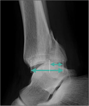 Medición del tamaño relativo del maléolo posterior en relación con el porcentaje de compromiso de la superficie articular tibial en la radiografía lateral de tobillo. Este método de medición ha sido utilizado clásicamente, a pesar de su escasa precisión.