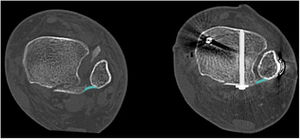 Cortes axiales de TAC de tobillo en los que se grafica la modificación de la tensión del ligamento tibiofibular posteroinferior posterior a la reducción y fijación de la FMP que compromete la incisura fibular.
