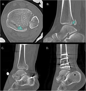 A y B. Cortes axial y sagital de TAC que evidencian la presencia de un fragmento intercalar en un paciente con FMP Bartoníček y Rammelt tipo III. C y D. Cortes sagitales de TAC pre y postoperatorio en paciente con FMP Bartoníček y Rammelt tipo II con fragmento intercalar que se fijó mediante un abordaje posterolateral.