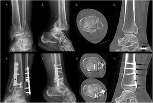 A-D. Radiografías y TAC preoperatorio y (E-H) postoperatorio de paciente con una luxofractura bimaleolar de tobillo con FMP Bartoníček y Rammelt tipo III que se fijó mediante un abordaje posteromedial modificado en decúbito supino (PMms) asociado a un abordaje lateral.