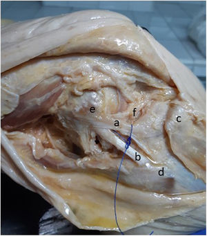 Región anterolateral de una rodilla derecha (a) LAL, (b) LCL, (c) tubérculo de Gerdy, (d) cabeza del peroné, (e) epicóndilo femoral lateral, (f) menisco lateral.