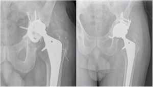 (A) X-ray of a patient diagnosed with aseptic loosening of the left hip acetabular component with Paprosky type IIIA acetabular defect. (B) X-ray control three years after surgery to replace the acetabular component with a trabecular titanium Cup-Cage implant (Delta-Revision TT [Lima Corporate®]). TT: TRABECULAR titanium.