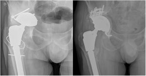 (A) X-ray of a patient diagnosed with aseptic loosening of right hip acetabular component with Paprosky type IIIB acetabular defect associated with pelvic discontinuity. (B) Control X-ray at two years after revision of the cup to a trabecular titanium Cup-Cage implant (Delta-Revision TT [Lima Corporate®]). TT: trabecular titanium.