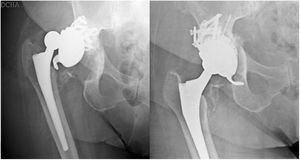 (A) Control X-ray of a patient one month after placement of a trabecular titanium cup (Delta-Revision TT [Lima Corporate®]) showing early loosening of the implant. (B) Radiographic control at six months after replacement of this component with a new revision cup (Delta-Revision TT [Lima Corporate®]) modifying the acetabular orientation and combining increased trabecular titanium in the tectal region. TT: trabecular titanium.