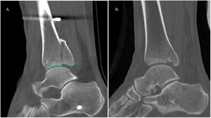 (A) Assessment of the intra-articular step-off on a sagittal CT scan of the ankle. (B) A 46-year-old male patient with an ankle injury due to torsional and axial compression mechanism. The sagittal CT section shows a PMF with tibial plafond impaction.