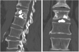 Imagen de la TAC postoperatoria, corte coronal (der.) y sagital (izq.), donde se observa la fuga de cemento al disco.