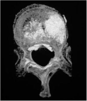 Imagen de la TAC postoperatoria, corte axial, donde se observa la fuga de cemento posterior, intracanal y a su vez anterior, en vena segmentaria.