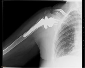Consolidación correcta de las tuberosidades.