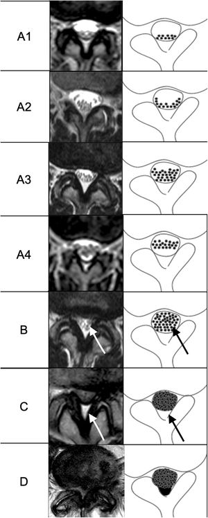 Representación de IRM y esquemática de la clasificación de Schizas para la estenosis lumbar. Las flechas de la imagen B muestran las radículas individualizadas que establecen la diferencia en cuanto a estenosis de grado B o moderada y estenosis de grado C o severa. Las flechas de la imagen C muestran la presencia de grasa epidural posterior que establece la diferencia entre estenosis de grado C o severa y estenosis de grado D o extrema.