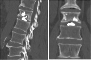 Postoperative CT image, coronal section (right) and sagittal section (left), showing leakage of cement to the disc.