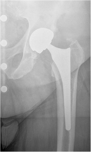 Total hip prosthesis with M–M bearing pair.