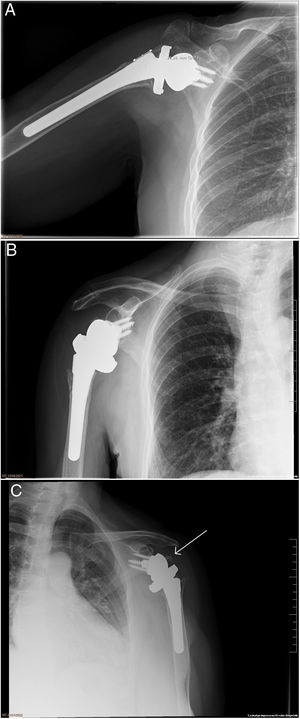 (a) Separation >1cm from the humeral diaphysis. (b) Absence of tuberosities. (c) Tuberosity above the tray (malunion).