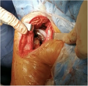 Impingement of the humeral tray (44mm) with the conjoined tendon.