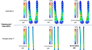 Map of the maximum stress values measured at the implant for the osteosyntheses analysed.