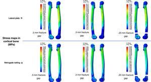 Map of the maximum stress values measured in the cortical bone for the osteosyntheses analysed.