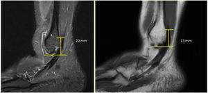 Measurement of the height of the peroneus brevis muscle belly from the tip of the fibula. (A) Patient with normal attachment (>15mm from the tip of the fibula). (B) Patient with low attachment (<15mm from the tip of the fibula).