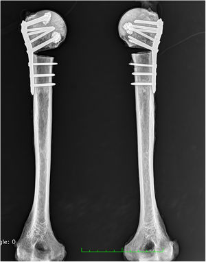 Radiografía de húmeros con tornillos cementados y osteotomía: el húmero derecho con la configuración clásica (hileras A y E) y el húmero izquierdo con la nueva configuración (hileras B y D).