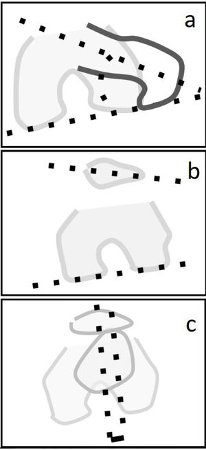 FAVA femoral anteversion angle (a), patella tilt (b), and tibial tuberosity–trochlear groove distance (TTTG) angle (c).