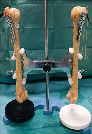 Humerus fixation with locked plate and screws.