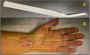 (A) Kemis H3® knife (Newclip). (B) Anatomical landmarks to section the TCL.