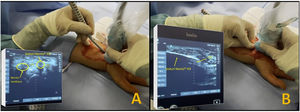 Introduction through the incision of the Kemis H3® (Newclip) knife. (A) Short-axis (transverse) ultrasound view. (B) Long-axis ultrasound view (longitudinal).