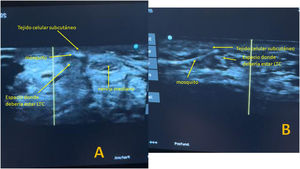 After section of the TCL, the mosquito forceps is reintroduced to check complete section of the TCL. (A) Short-axis ultrasound view. (B) Long-axis ultrasound view.
