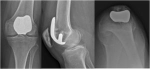 Radiografía de rodilla de una mujer de 72 años, inmediatamente tras una ATR en las 3 proyecciones radiológicas: anteroposterior, lateral y axial.