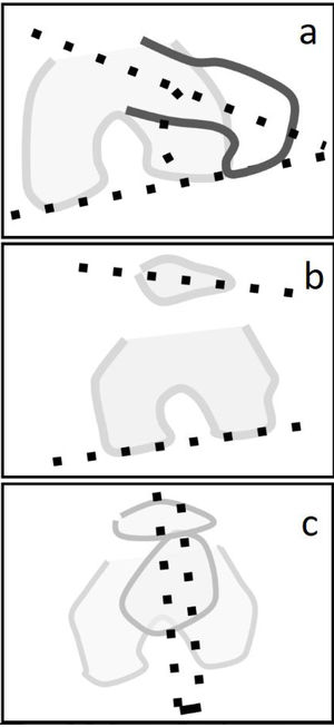 Ángulo de anteversión femoral FAVA (a), torsión rotuliana (b) y ángulo de la distancia tuberosidad tibial-surco troclear (TT-TG) (c).