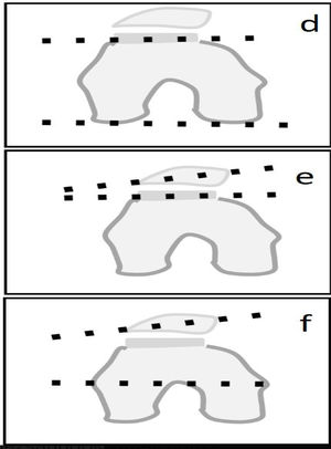 Ángulo LPT (d), torsión de la APF con respecto a la rótula (e) y ángulo de rotación (f).