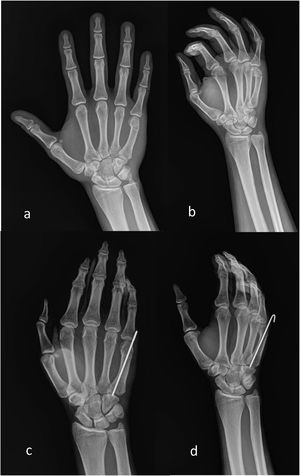 Radiografías preoperatorias (a y b) y radiografías postoperatorias (c y d) del procedimiento con aguja Kirschner retrógrada en pacientes con fractura de cuello de quinto metacarpiano.