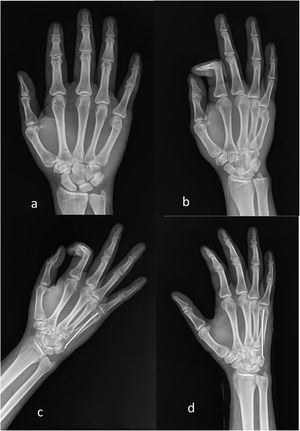 Radiografías preoperatorias (a y b) y radiografías postoperatorias (c y d) del procedimiento con aguja Kirschner anterógrada en pacientes con fractura de cuello de quinto metacarpiano.