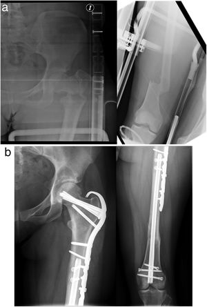 (a) Pre-operative AP radiographs of a 24-year-old woman with a complex proximal femoral fracture and ipsilateral shaft fracture 32-A3. (b) Post-operative AP radiographs showing fixation with retrograde femoral trigen Meta-Nail (S&N) for the FSF combined with a hook locking compression plate (LCP, DePuy Synthes) with two interfragmentary compression cancellous screw (CS).