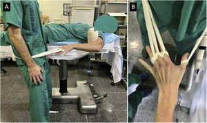 (A) Traction technique used. (B) Detail of the finger-fixing system.